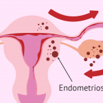 Endometriosis