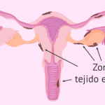 ¿Qué provoca la endometriosis?