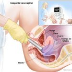 ¿El ultrasonido transvaginal es seguro?